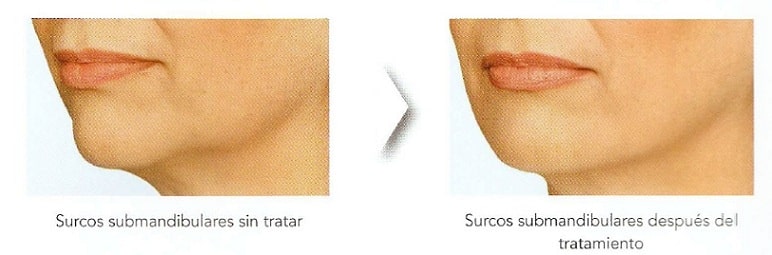 Reafirmar la linea mandibular y el cuello con Radiesse