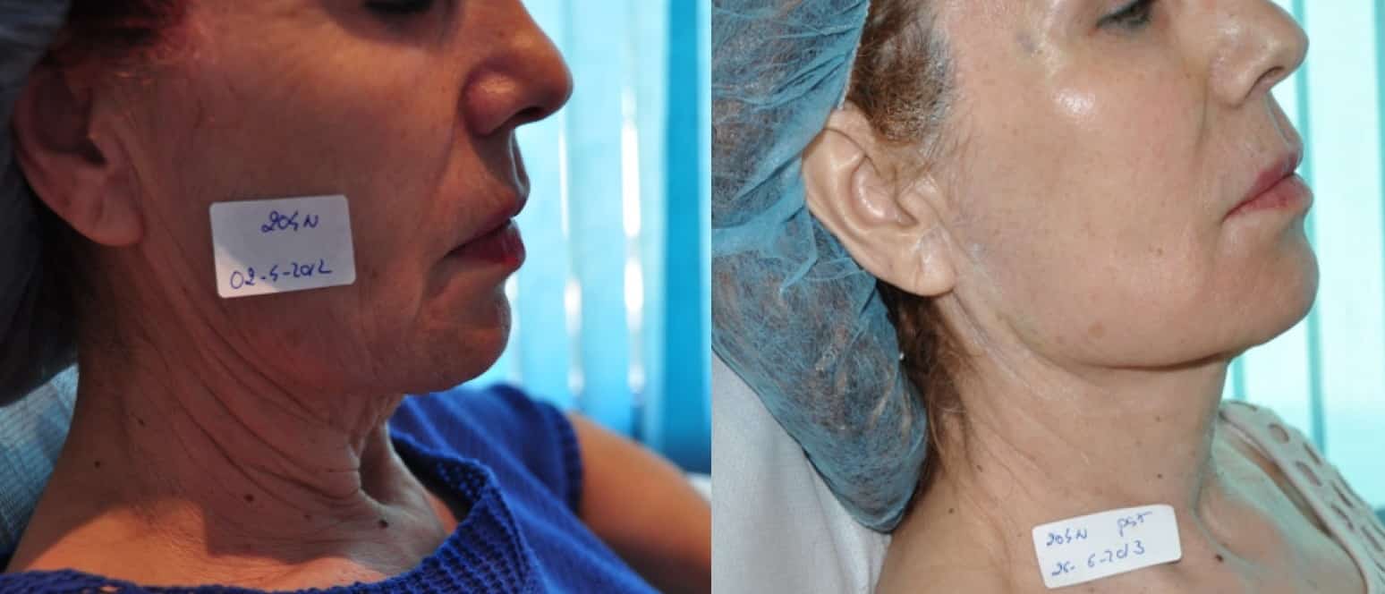 Lifting Facial sin cirugía 3 sesiones