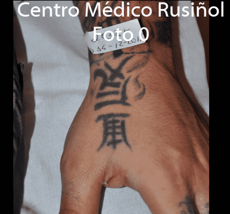 Eliminación tatuajes CMR. Tatuaje nº3