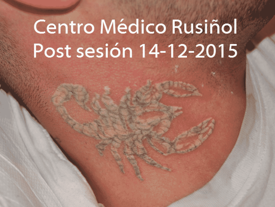 Post sesion laser de tatuajes CMR