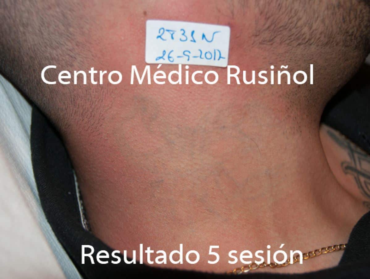 Tatuaje cuello sesion 5 S
