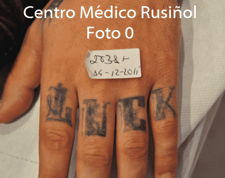 Eliminación tatuajes CMR. Tatuaje nº2