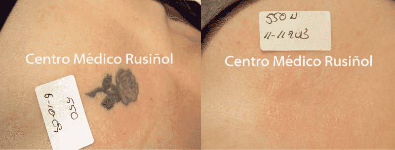 Tatuaje color antes y después CMR