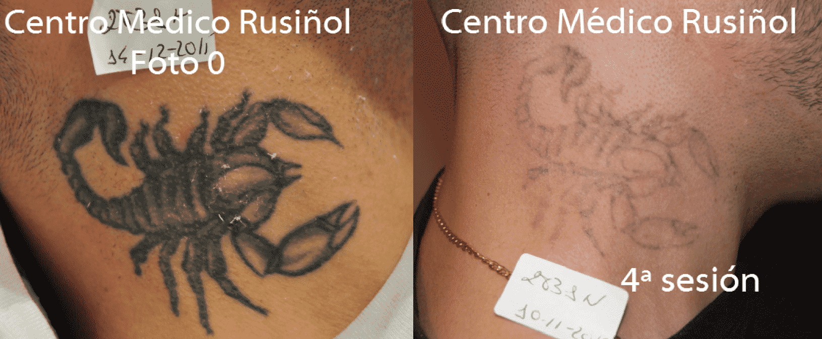 Eliminación láser de 4 tatuajes. Resultado de 4 sesiones