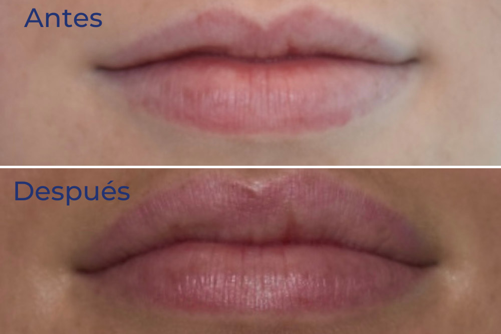 aumento labios antes y después
