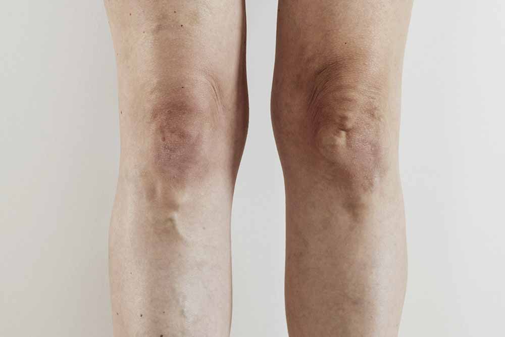 Drenaje linfático en piernas: antes y después - Centro Médico Estético  Rusiñol
