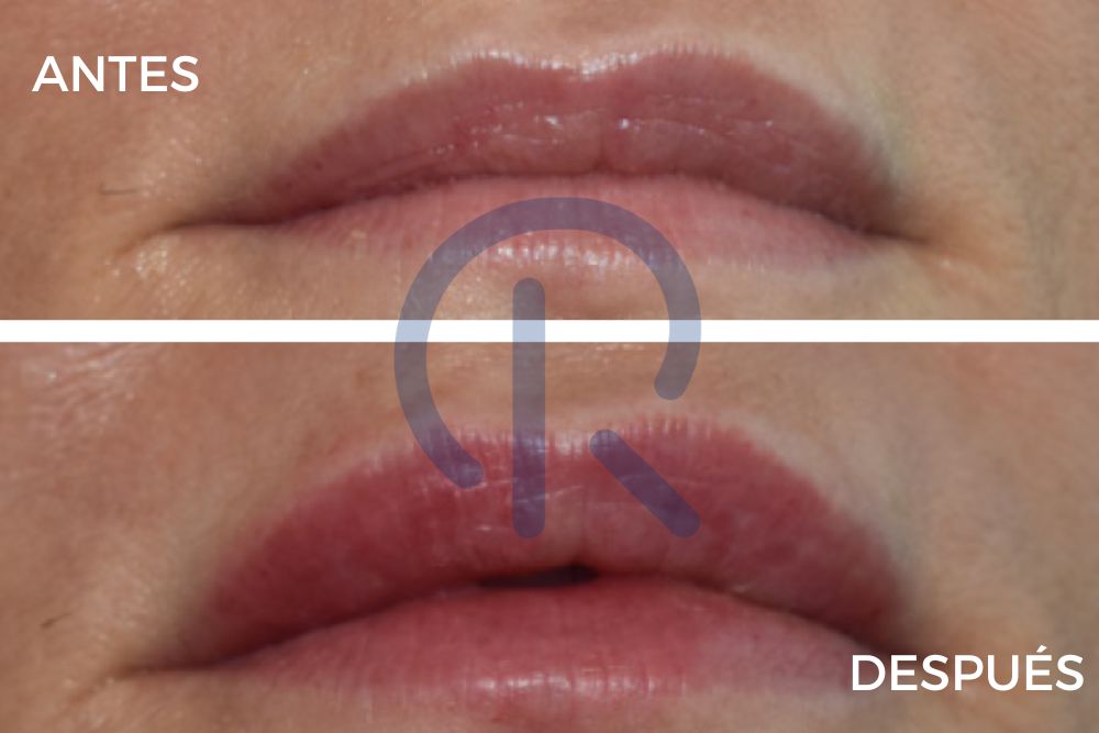 Aumento labios sin cirugía antes y después